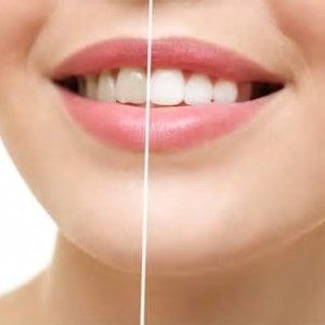 sbiancamento denti Palermo