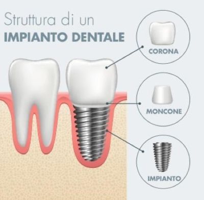 Impianto dentale
